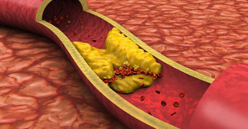 Kolesterol Nedir? Kolesterol Belirtileri Nelerdir?
